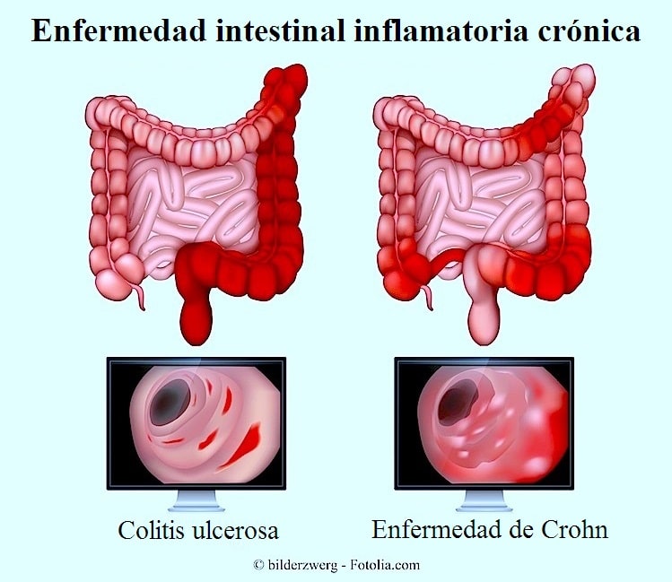 Colitis Ulcerativa Crónica